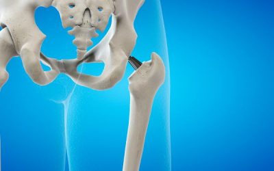 Why Should I Have a Hip Replacement?