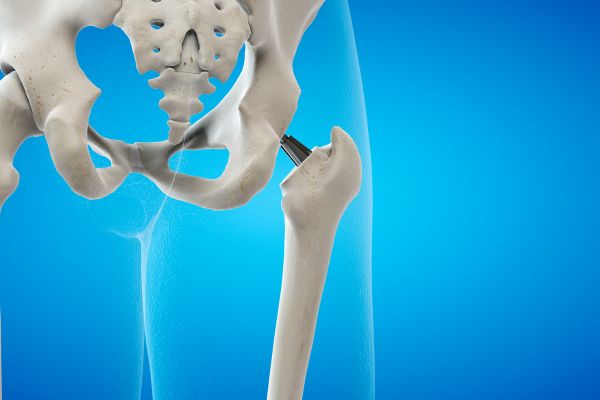 Hip replacement surgery