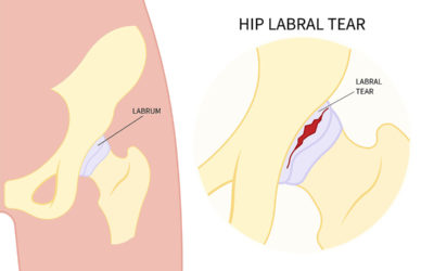 How to Treat a Labral Tear
