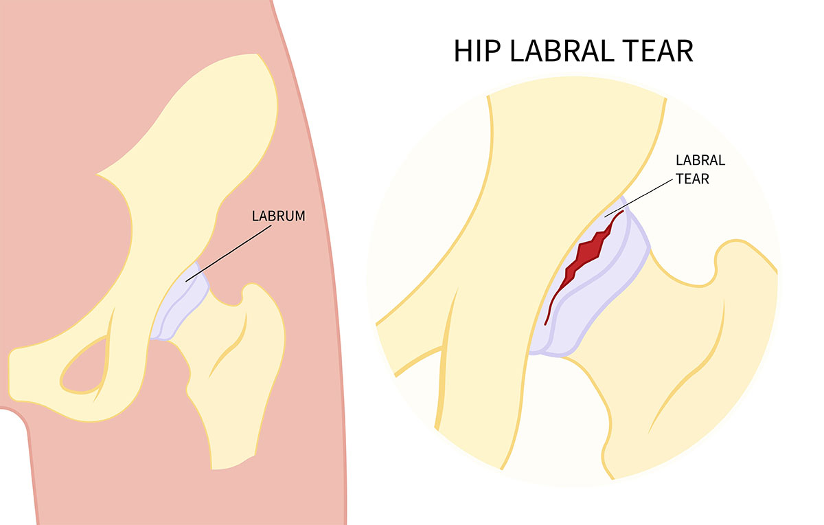 treat-a-labral-tear