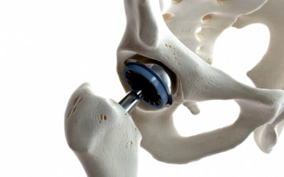 What You Should Know About Hip Arthroscopy Labral Repair