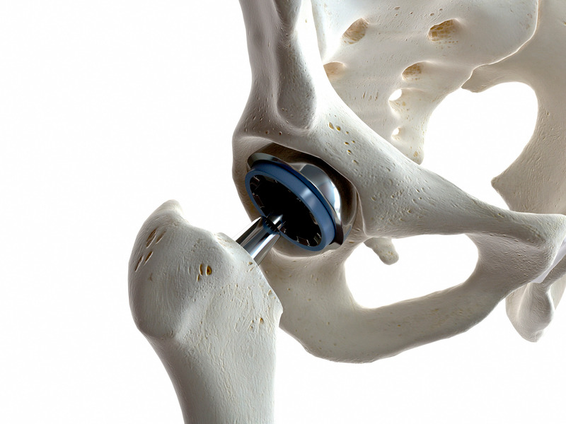 Hip arthroscopy labral repair