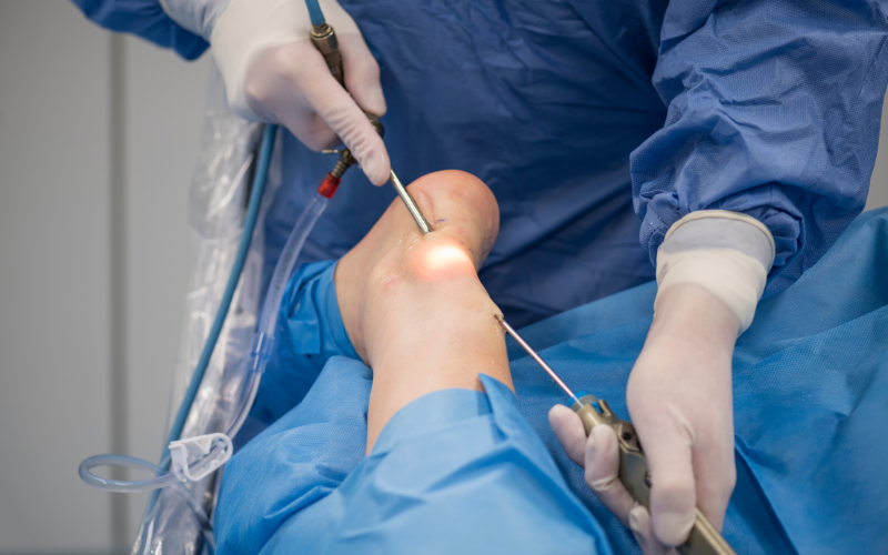 ankle arthroscopy