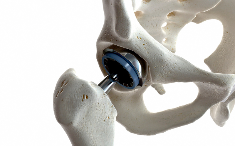 partial hip replacement