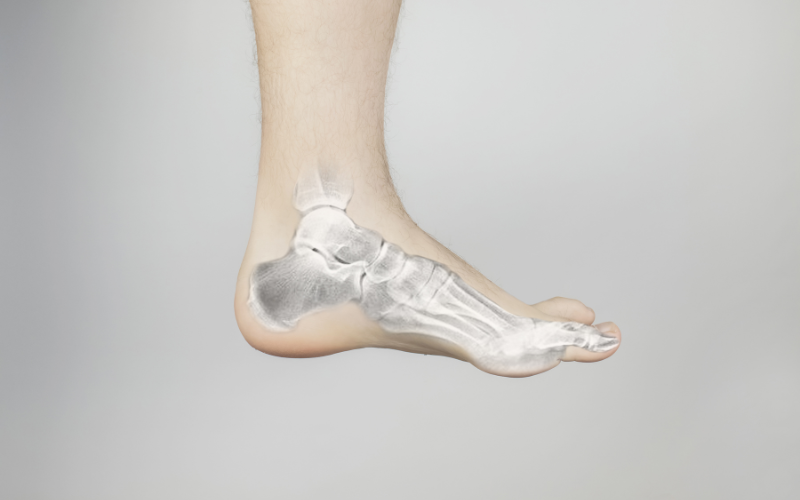 foot fracture