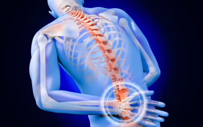 Back Pain with Leg Numbness? You Might Have Sciatica