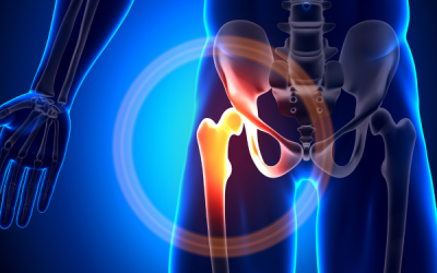 Hip Arthritis vs. Hip Labral Tear: How to Tell the Difference