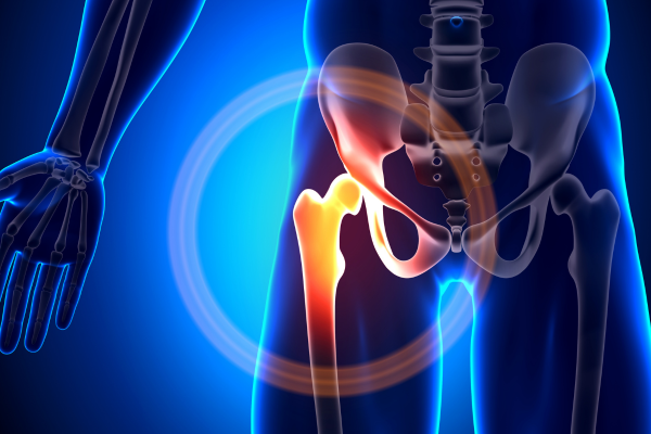 Hip Arthritis vs. Hip Labral Tear