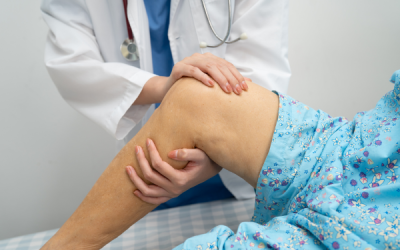 Knee Arthritis: Symptoms, Stages, and Treatment Options