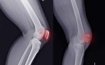 Knee Fracture Treatment in East Tennessee