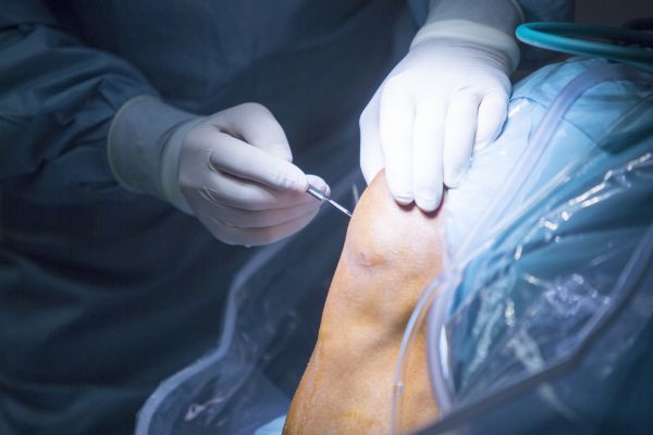 Knee Meniscus and ACL Surgery Knee Meniscus and ACL Surgery